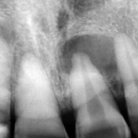 Root canal procedure steps at Dhanesh Dental Care Thoothukudi