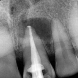 Root canal procedure steps at Dhanesh Dental Care Thoothukudi