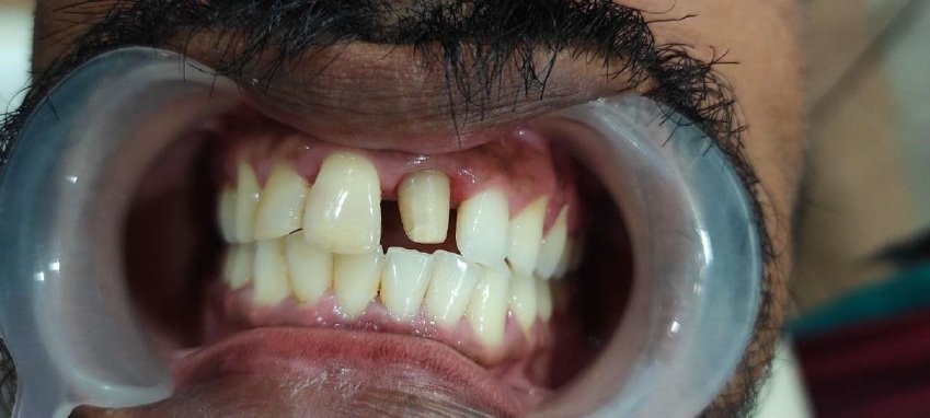 Root canal procedure steps at Dhanesh Dental Care Thoothukudi